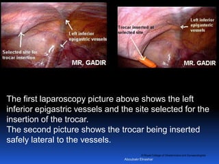 © Royal College of Obstetricians and Gynaecologists
The first laparoscopy picture above shows the left
inferior epigastric vessels and the site selected for the
insertion of the trocar.
The second picture shows the trocar being inserted
safely lateral to the vessels.
Aboubakr Elnashar
 