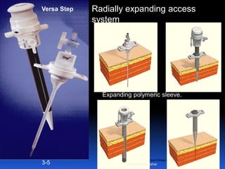 © Royal College of Obstetricians and Gynaecologists
Versa Step
3-5
Radially expanding access
system
Expanding polymeric sleeve.
Aboubakr Elnashar
 