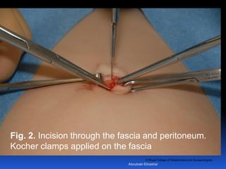 © Royal College of Obstetricians and Gynaecologists
Fig. 2. Incision through the fascia and peritoneum.
Kocher clamps applied on the fascia
Aboubakr Elnashar
 