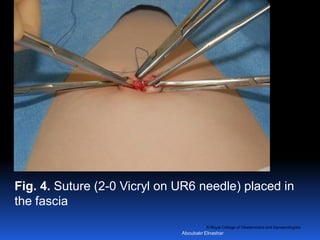 © Royal College of Obstetricians and Gynaecologists
Fig. 4. Suture (2-0 Vicryl on UR6 needle) placed in
the fascia
Aboubakr Elnashar
 