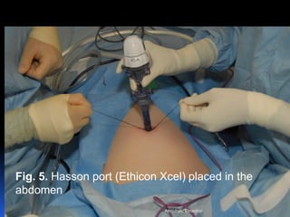 © Royal College of Obstetricians and Gynaecologists
Fig. 5. Hasson port (Ethicon Xcel) placed in the
abdomen
Aboubakr Elnashar
 