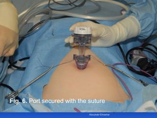 © Royal College of Obstetricians and Gynaecologists
Fig. 6. Port secured with the suture
Aboubakr Elnashar
 