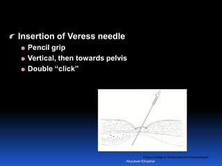 © Royal College of Obstetricians and Gynaecologists
Insertion of Veress needle
Pencil grip
Vertical, then towards pelvis
Double “click”
Aboubakr Elnashar
 