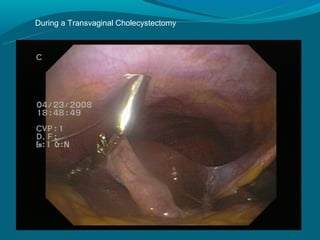 During a Transvaginal Cholecystectomy
 