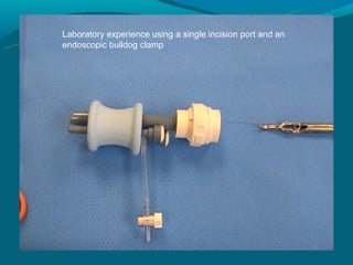 Laboratory experience using a single incision port and an
endoscopic bulldog clamp
 