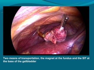 Two means of transportation, the magnet at the fundus and the SIT at
the base of the gallbladder
 