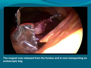 The magnet was released from the fundus and is now transporting an
endoscopic bag
 