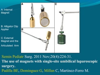 A: Internal
Magnet




B: Alligator Clip
Applier


C: External
Magnet and the
Articulated Arm



Semin Pediatr Surg. 2011 Nov;20(4):224-31.
The use of magnets with single-site umbilical laparoscopic
surgery.
Padilla BE, Dominguez G, Millan C, Martinez-Ferro M.
 