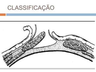 CLASSIFICAÇÃO
 