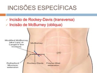 INCISÕES ESPECÍFICAS
 Incisão de Rockey-Davis (transversa)
 Incisão de McBurney (obliqua)
 