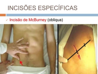 INCISÕES ESPECÍFICAS
 Incisão de McBurney (obliqua)
 