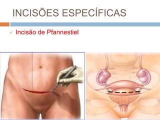 INCISÕES ESPECÍFICAS
 Incisão de Pfannestiel
 