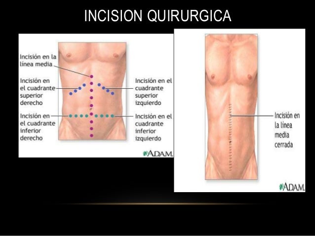 laparotomia exploradora tecnica quirurgica