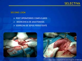  POST OPERATORIOS COMPLICADOS
 DESHICENCIA DE ANASTOMOSIS
 SOSPECHA DE SEPSIS PERSISTENTE




                                   http://www.compumedicina.com/cirugia/cir_011003.htm
 