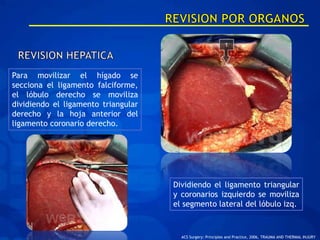 Para movilizar el hígado se
secciona el ligamento falciforme,
el lóbulo derecho se moviliza
dividiendo el ligamento triangular
derecho y la hoja anterior del
ligamento coronario derecho.




                                     Dividiendo el ligamento triangular
                                     y coronarios izquierdo se moviliza
                                     el segmento lateral del lóbulo izq.


                                       ACS Surgery: Principles and Practice, 2006, TRAUMA AND THERMAL INJURY
 