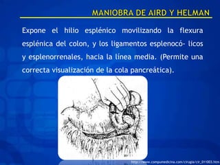 Expone el hilio esplénico movilizando la flexura
esplénica del colon, y los ligamentos esplenocó- licos
y esplenorrenales, hacia la línea media. (Permite una
correcta visualización de la cola pancreática).




                                 http://www.compumedicina.com/cirugia/cir_011003.htm
 