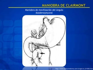 Maniobra de movilización del ángulo
         duodenoyeyunal




                           http://www.compumedicina.com/cirugia/cir_011003.htm
 