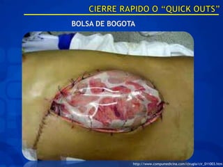 http://www.compumedicina.com/cirugia/cir_011003.htm
 