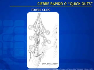 ACS Surgery: Principles and Practice, 2006, TRAUMA AND THERMAL INJURY
 