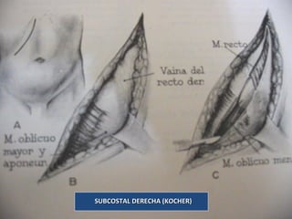 15
SUBCOSTAL DERECHA (KOCHER)SUBCOSTAL DERECHA (KOCHER)
 