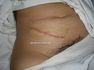 18
Mc Burney ampliadaMc Burney ampliada
 