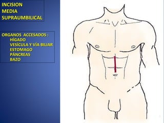INCISIONINCISION
MEDIAMEDIA
SUPRAUMBILICALSUPRAUMBILICAL
ORGANOS ACCESADOS :ORGANOS ACCESADOS :
HÍGADOHÍGADO
VESÍCULA Y VÍA BILIARVESÍCULA Y VÍA BILIAR
ESTOMAGOESTOMAGO
PÁNCREASPÁNCREAS
BAZOBAZO
 