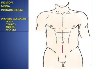 INCISIONINCISION
MEDIAMEDIA
INFRAUMBILICALINFRAUMBILICAL
ORGANOS ACCESADOS :ORGANOS ACCESADOS :
VEJIGAVEJIGA
OVARIOSOVARIOS
ANEXOSANEXOS
APÉNDICEAPÉNDICE
 