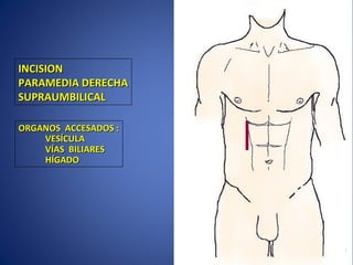 INCISIONINCISION
PARAMEDIA DERECHAPARAMEDIA DERECHA
SUPRAUMBILICALSUPRAUMBILICAL
ORGANOS ACCESADOS :ORGANOS ACCESADOS :
VESÍCULAVESÍCULA
VÍAS BILIARESVÍAS BILIARES
HÍGADOHÍGADO
 