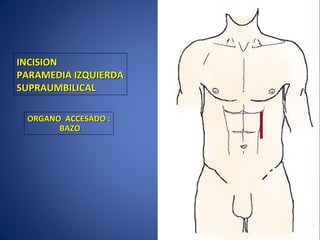 INCISIONINCISION
PARAMEDIA IZQUIERDAPARAMEDIA IZQUIERDA
SUPRAUMBILICALSUPRAUMBILICAL
ORGANO ACCESADO :ORGANO ACCESADO :
BAZOBAZO
 