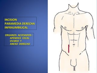 INCISIONINCISION
PARAMEDIA DERECHAPARAMEDIA DERECHA
INFRAUMBILICALINFRAUMBILICAL
ORGANOS ACCESADOS :ORGANOS ACCESADOS :
APÉNDICE CECALAPÉNDICE CECAL
OVARIO YOVARIO Y
ANEXO DERECHOANEXO DERECHO
 