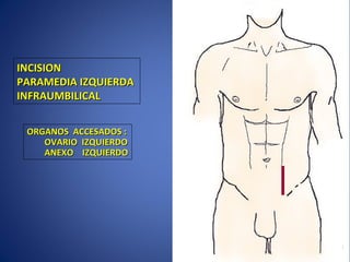 INCISIONINCISION
PARAMEDIA IZQUIERDAPARAMEDIA IZQUIERDA
INFRAUMBILICALINFRAUMBILICAL
ORGANOS ACCESADOS :ORGANOS ACCESADOS :
OVARIO IZQUIERDOOVARIO IZQUIERDO
ANEXO IZQUIERDOANEXO IZQUIERDO
 