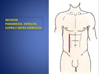 INCISIONINCISION
PARAMEDIA DERECHAPARAMEDIA DERECHA
SUPRA E INFRA UMBILICALSUPRA E INFRA UMBILICAL
 