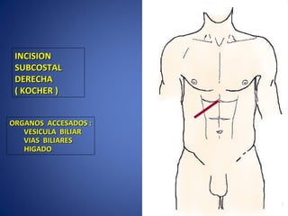 INCISIONINCISION
SUBCOSTALSUBCOSTAL
DERECHADERECHA
( KOCHER )( KOCHER )
ORGANOS ACCESADOS :ORGANOS ACCESADOS :
VESICULA BILIARVESICULA BILIAR
VIAS BILIARESVIAS BILIARES
HIGADOHIGADO
 