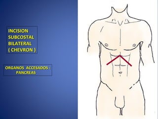 INCISIONINCISION
SUBCOSTALSUBCOSTAL
BILATERALBILATERAL
( CHEVRON )( CHEVRON )
ORGANOS ACCESADOS :ORGANOS ACCESADOS :
PANCREASPANCREAS
 