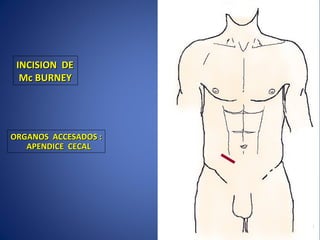 INCISION DEINCISION DE
Mc BURNEYMc BURNEY
ORGANOS ACCESADOS :ORGANOS ACCESADOS :
APENDICE CECALAPENDICE CECAL
 