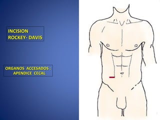 INCISIONINCISION
ROCKEY- DAVISROCKEY- DAVIS
ORGANOS ACCESADOS :ORGANOS ACCESADOS :
APENDICE CECALAPENDICE CECAL
 