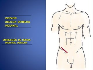 INCISIONINCISION
OBLICUA DERECHAOBLICUA DERECHA
INGUINALINGUINAL
CORRECCIÓN DE HERNIACORRECCIÓN DE HERNIA
INGUINAL DERECHAINGUINAL DERECHA
 