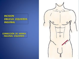 INCISIONINCISION
OBLICUA IZQUIERDAOBLICUA IZQUIERDA
INGUINALINGUINAL
CORRECCIÓN DE HERNIACORRECCIÓN DE HERNIA
INGUINAL IZQUIERDAINGUINAL IZQUIERDA
 