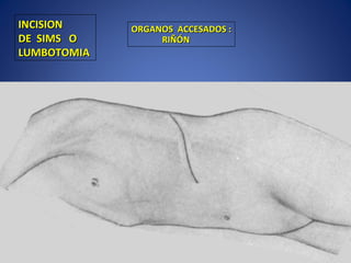 INCISIONINCISION
DE SIMS ODE SIMS O
LUMBOTOMIALUMBOTOMIA
ORGANOS ACCESADOS :ORGANOS ACCESADOS :
RIÑÓNRIÑÓN
 