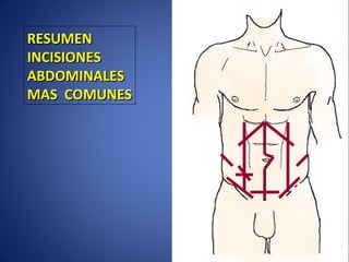 RESUMENRESUMEN
INCISIONESINCISIONES
ABDOMINALESABDOMINALES
MAS COMUNESMAS COMUNES
 