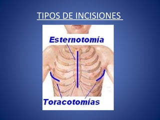 TIPOS DE INCISIONES
 