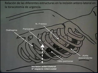 Relación de las diferentes estructuras en la incisión antero-lateral en
la toracotomía de urgencia.
 
