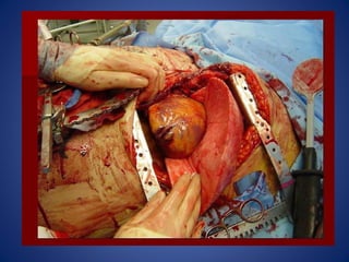 Laparotomia y toracotomia