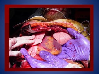 Laparotomia y toracotomia