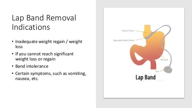 Lap Band Conversion to Gastric Sleeve