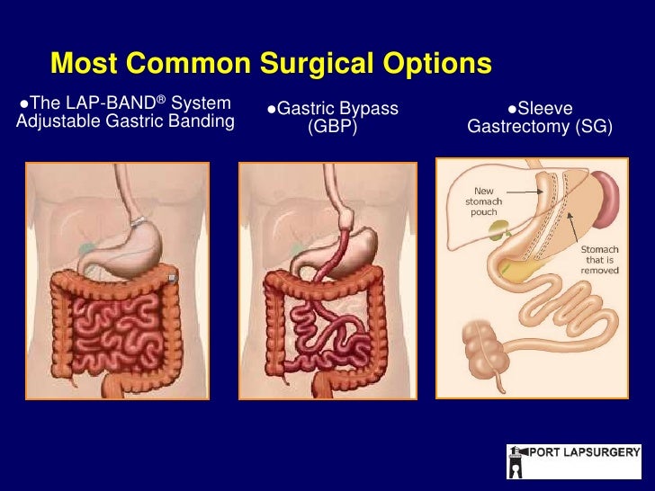 Lapband Seminar PORT LAPSURGERY