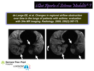 ¿Qué Aporta el Sistema ModuliteR ?
de Lange EE, et al. Changes in regional airflow obstruction
 over time in the lungs of patients with asthma: evaluation
  with 3He MR imaging. Radiology. 2009; 250(2):567-75.
 