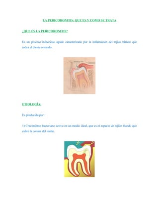 LA PERICORONITIS: QUE ES Y COMO SE TRATA


¿QUE ES LA PERICORONITIS?


Es un proceso infeccioso agudo caracterizado por la inflamación del tejido blando que
rodea el diente retenido.




ETIOLOGÍA:


Es producida por:


1) Crecimiento bacteriano activo en un medio ideal, que es el espacio de tejido blando que
cubre la corona del molar.
 