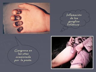 Inflamación
                    de los
                   ganglios
                 linfáticos .




Gangrena en
  las uñas
 ocasionada
por la peste.
 