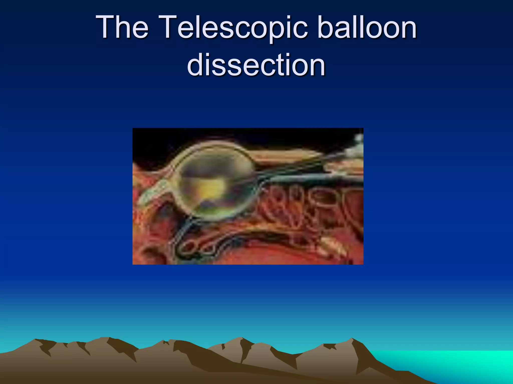 The Telescopic balloon
dissection
 